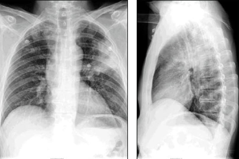Imágenes radiográficas de una neumona lobular.